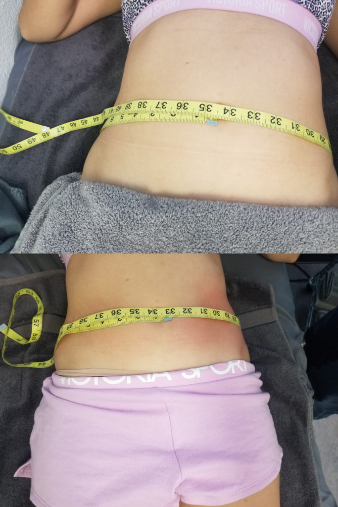 Bella CryoSlimming Before & After