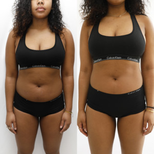 CryoSlimming - Abdomen CryoSlimming - Abdomen