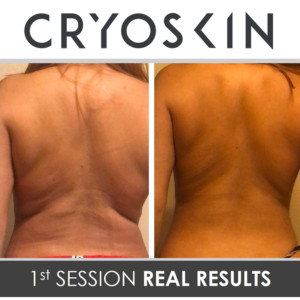 CryoSlimming - Back CryoSlimming - Back