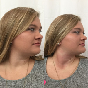 CryoToning Facial - Double Chin Reduction CryoToning Facial - Double Chin Reduction