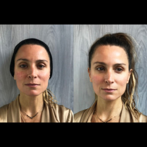 CryoToning Facial CryoToning Facial