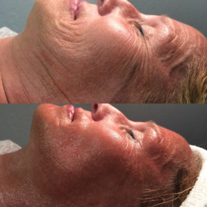 CryoToning Facial CryoToning Facial