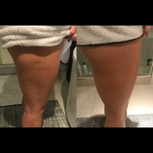 CryoToning Body - Legs CryoToning Body - Legs