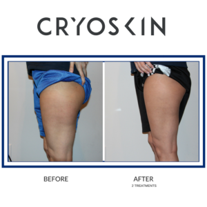 CryoSlimming - Legs CryoSlimming - Legs